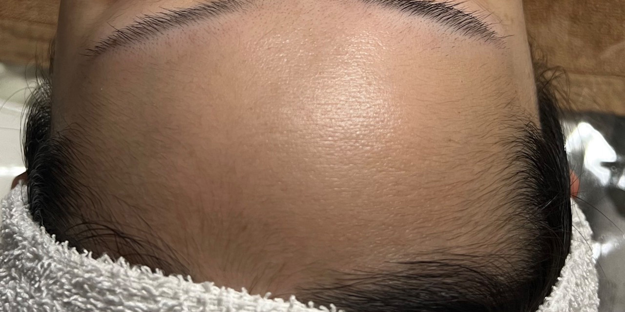 オールハンドフェイシャル施術前