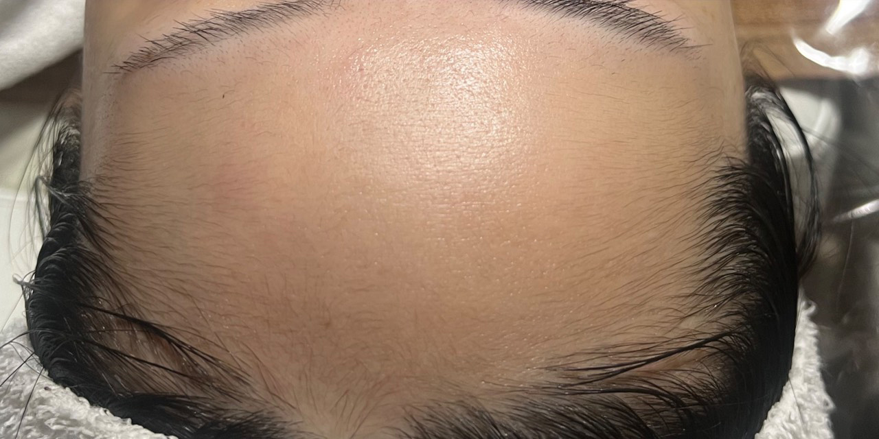 オールハンドフェイシャル施術後