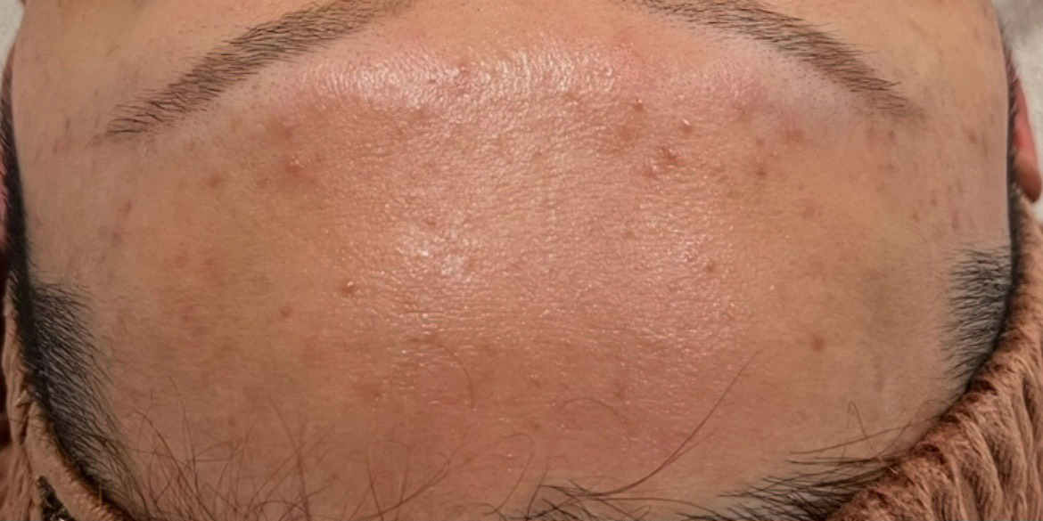 オールハンドフェイシャル施術前