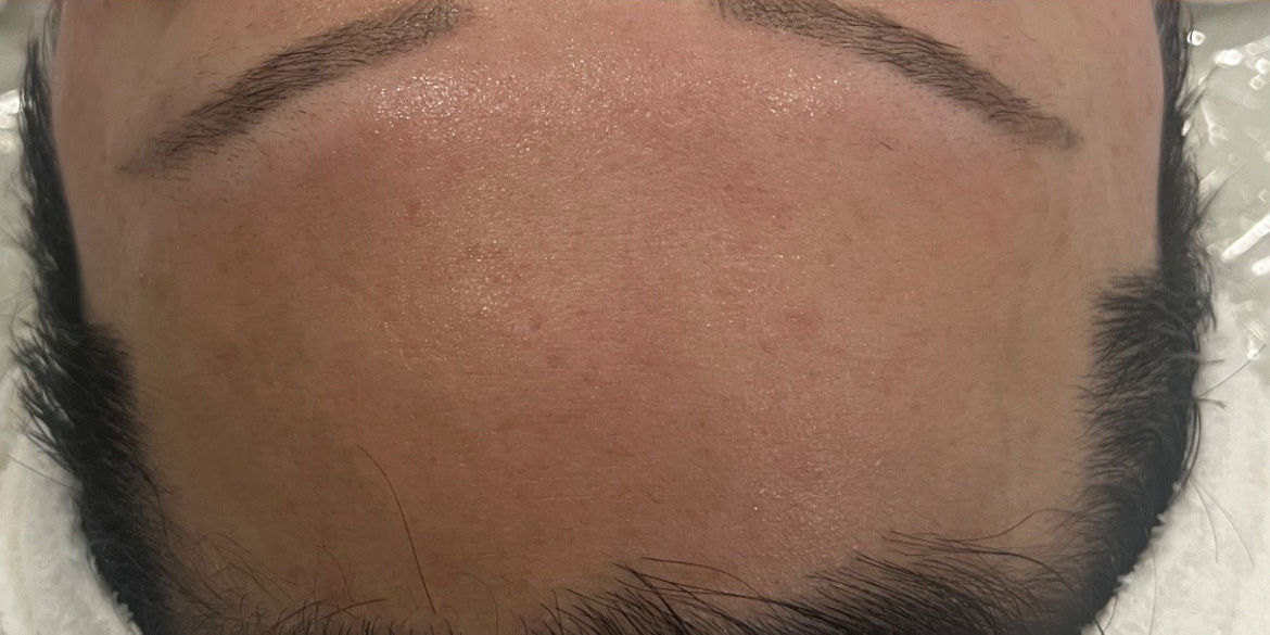 オールハンドフェイシャル施術後