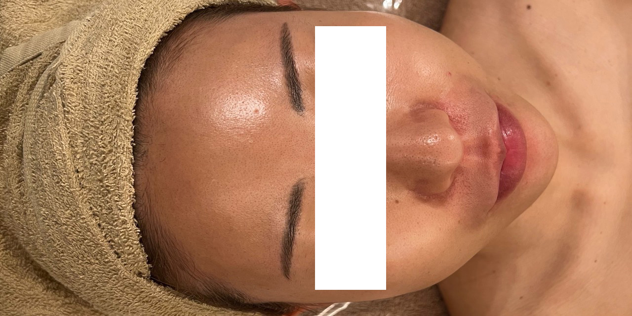 オールハンドフェイシャル施術前