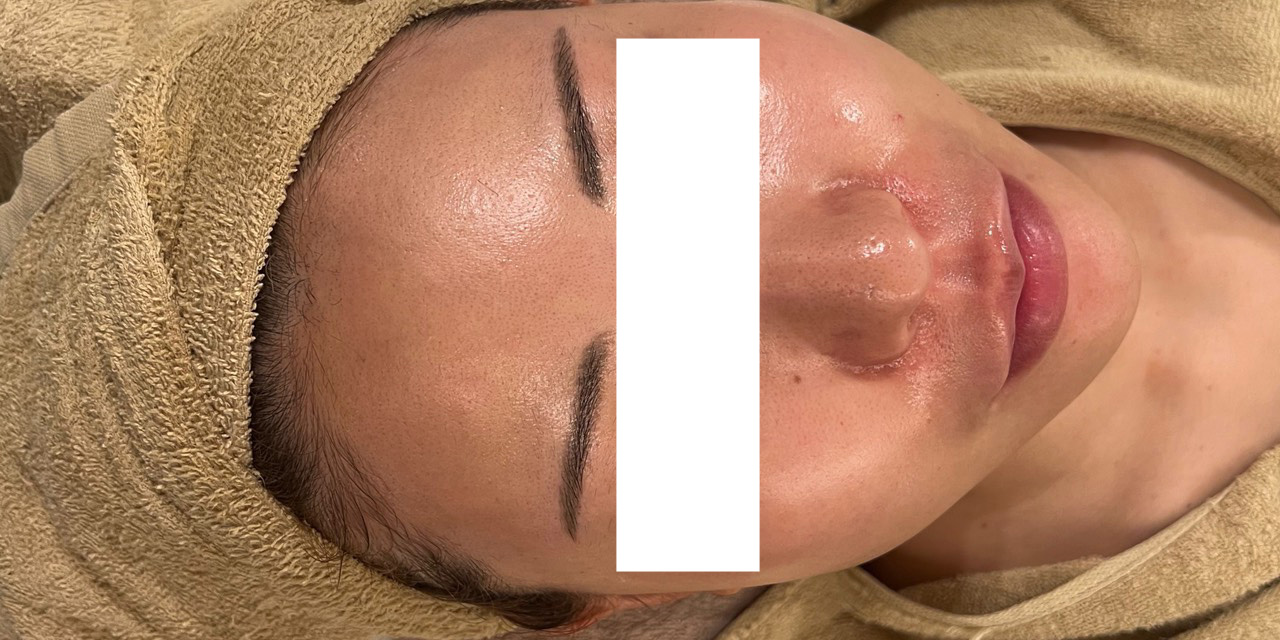 オールハンドフェイシャル施術後