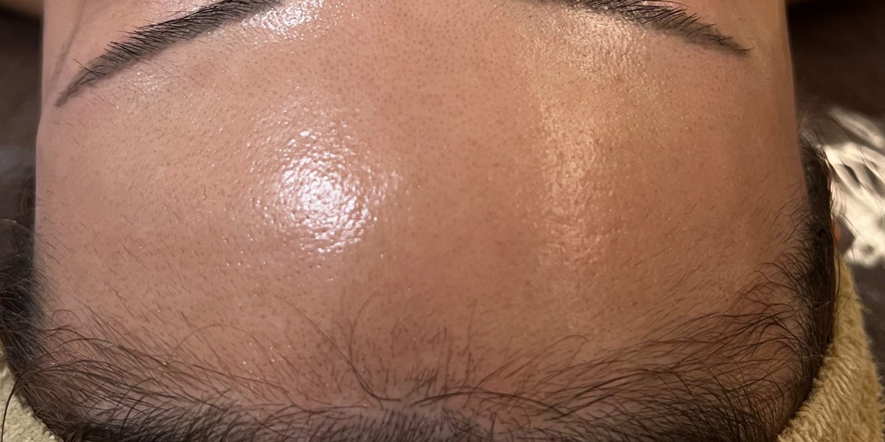 オールハンドフェイシャル施術後